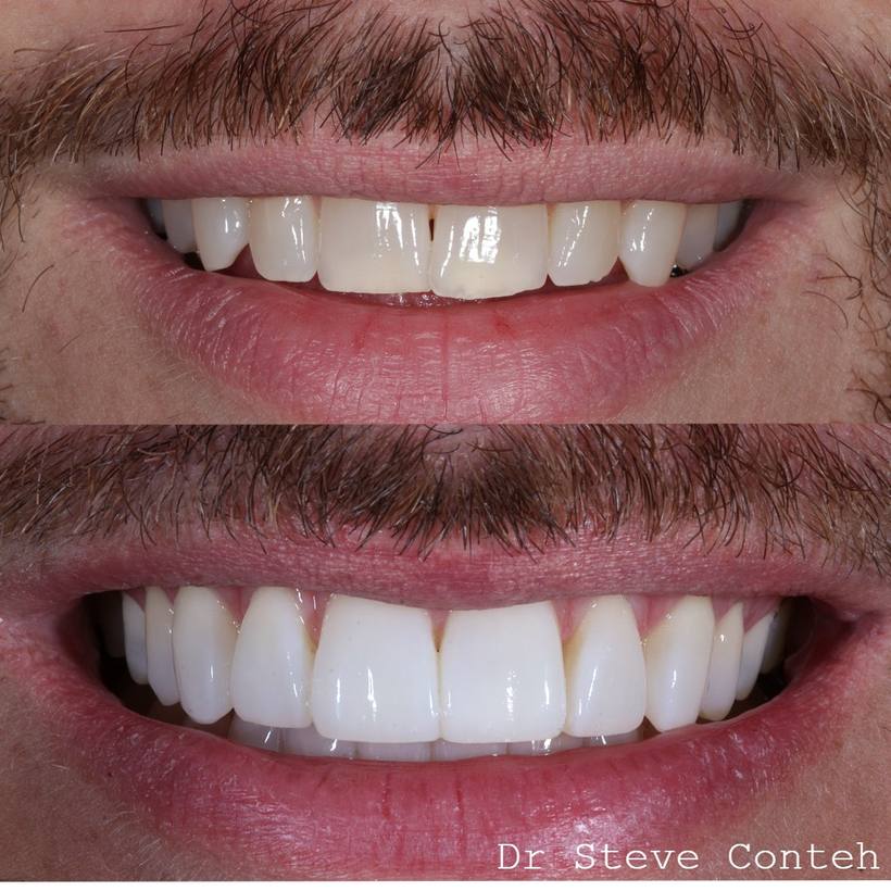 A - Align B - Brighten (whiten) C – Composite bonding on 8 teeth.