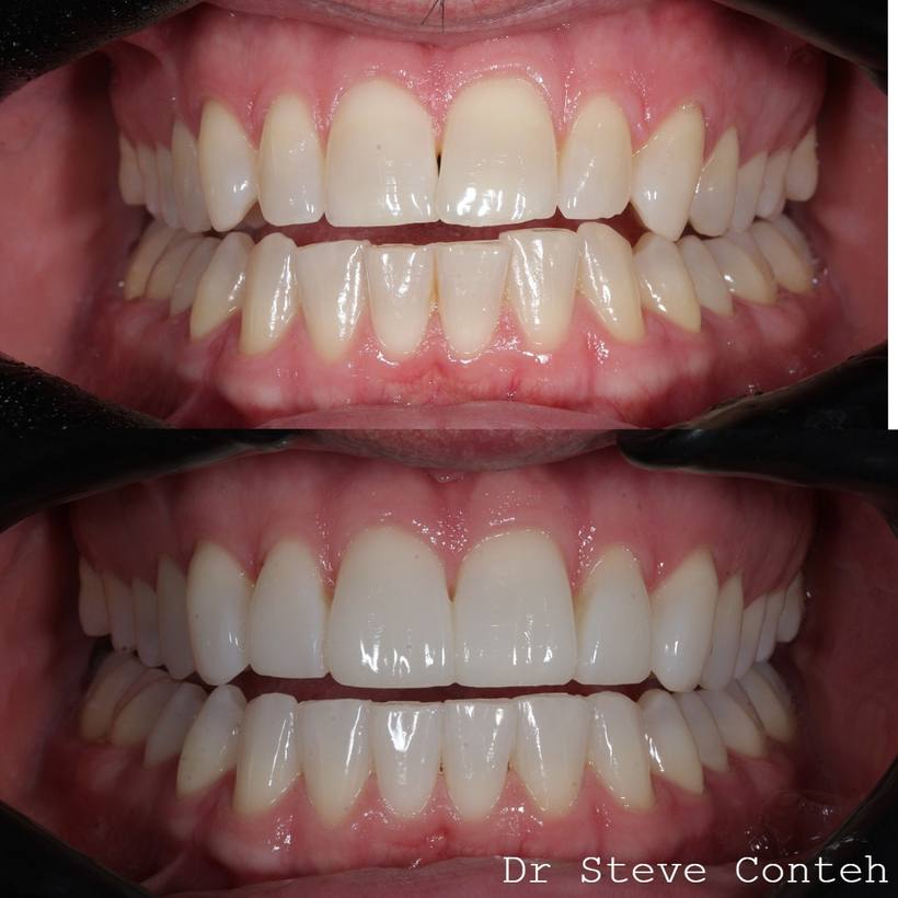 A - Align B - Brighten (whiten) C – Composite bonding on 8 teeth.