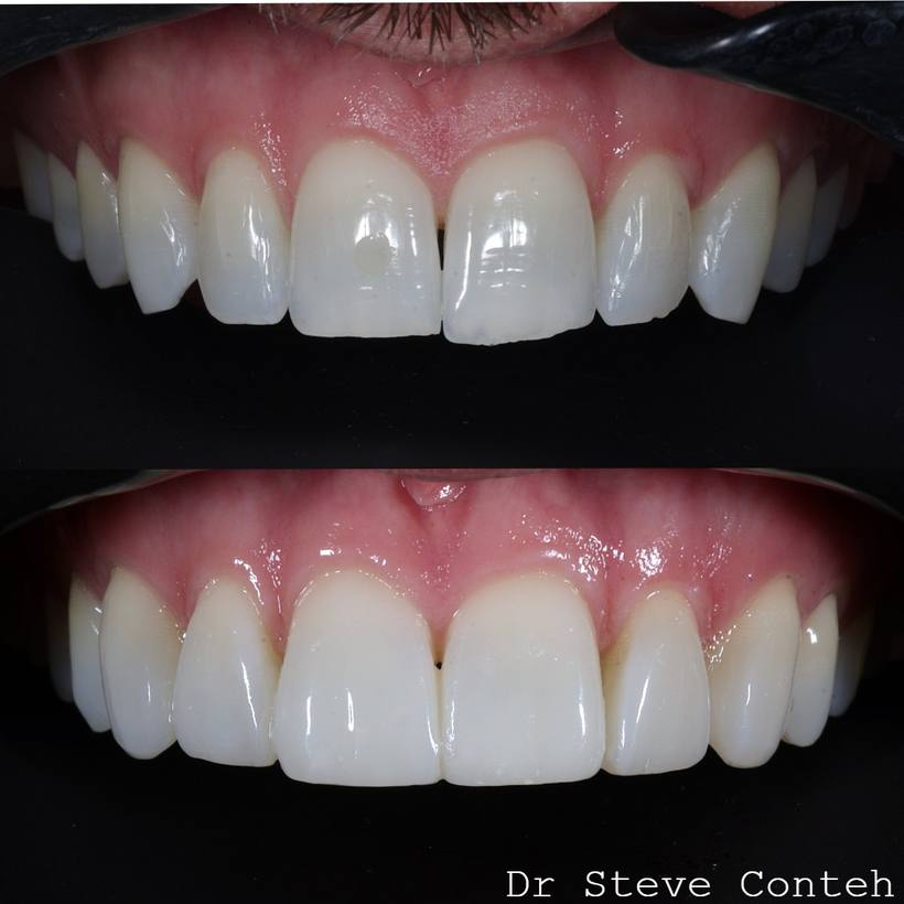 Composite bonding on eight teeth perfected this smile