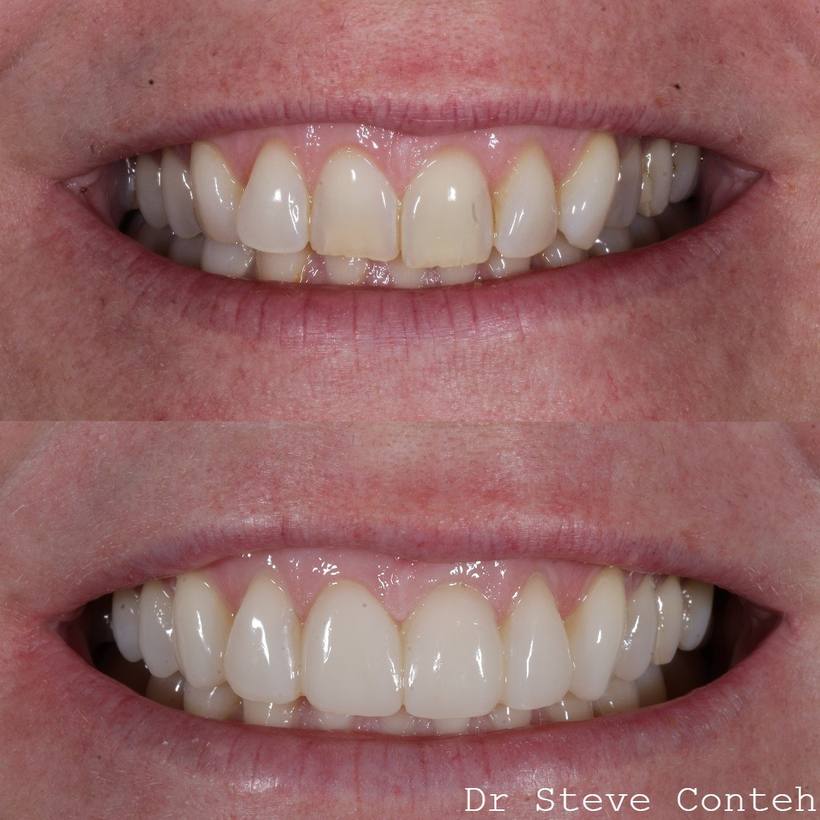 A - Align B - Brighten (whiten) C – Composite bonding on 8 teeth.