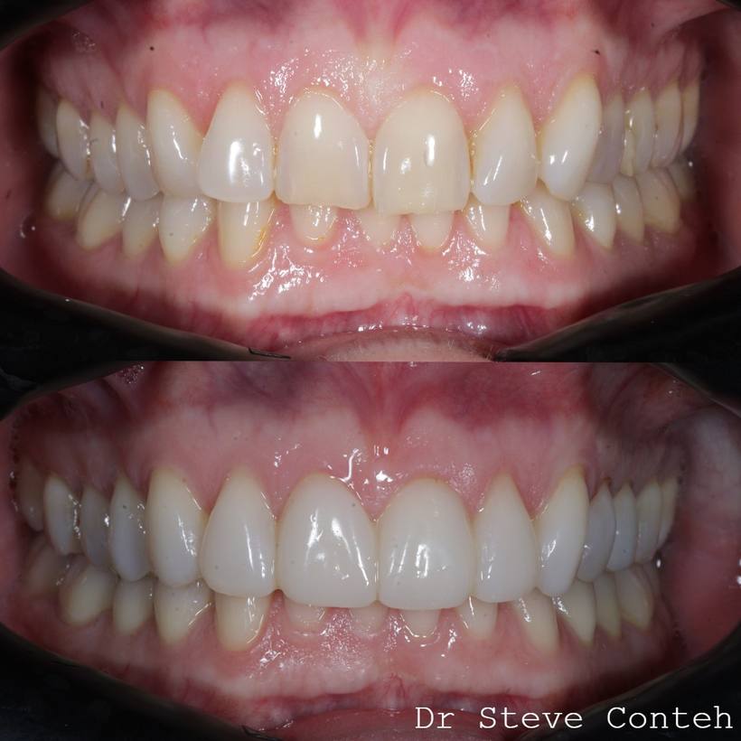 A - Align B - Brighten (whiten) C – Composite bonding on 8 teeth.