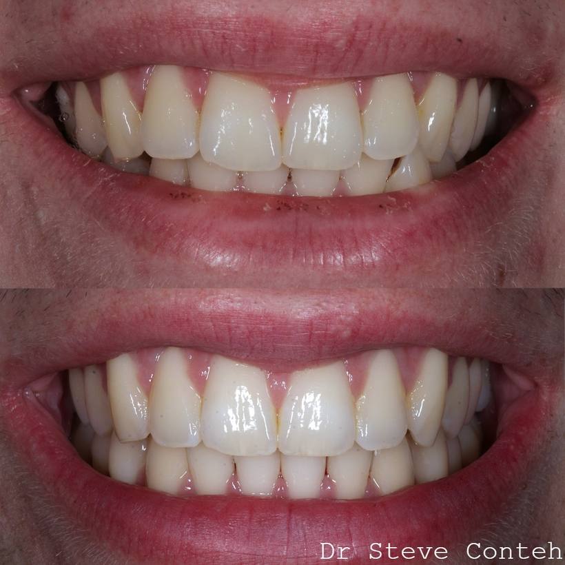 Invisalign corrected the crossbite and perfected this smile.