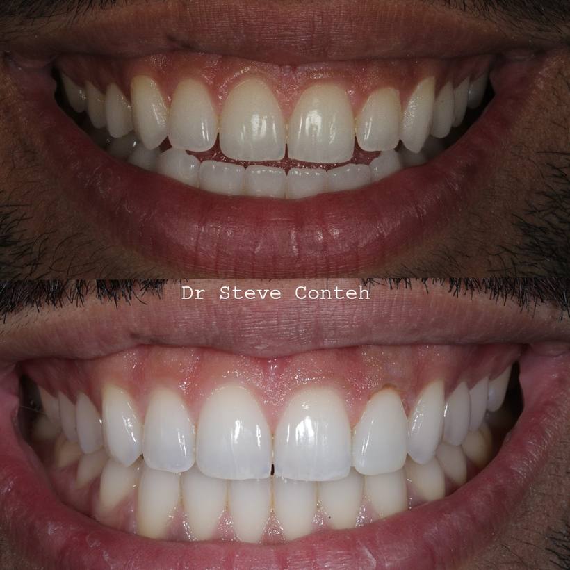 Invisalign, gum contouring and composite bonding on one tooth perfected this smile
