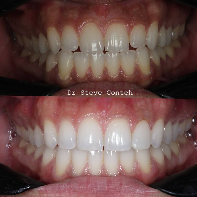 Invisalign, gum contouring and composite bonding on one tooth perfected this smile