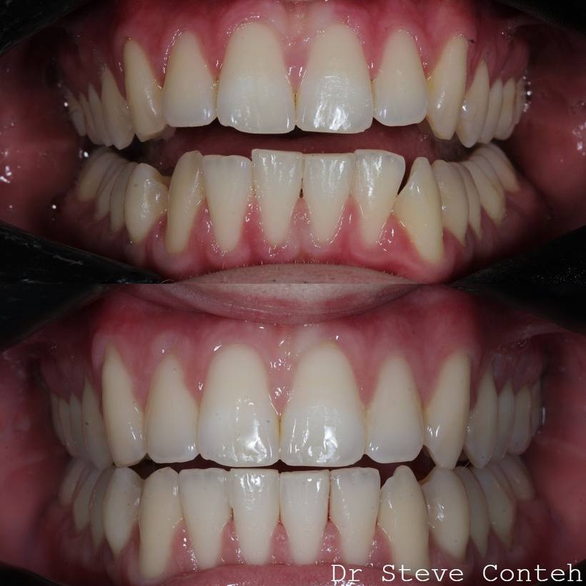 Invisalign corrected the crossbite and perfected this smile.