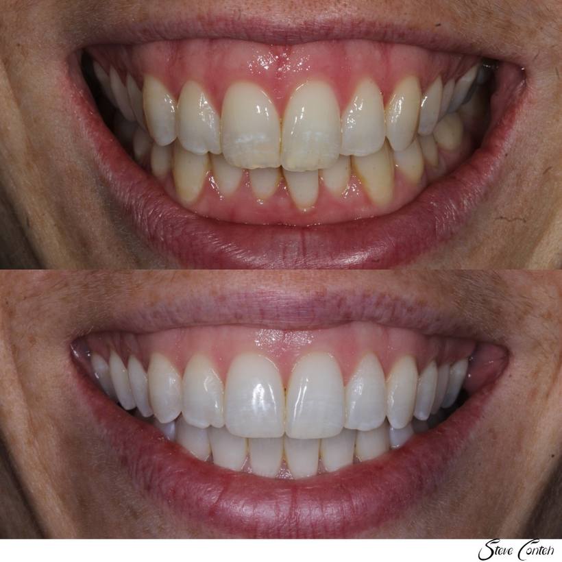 Invisalign and whitening corrected the crossbite and perfected this smile.