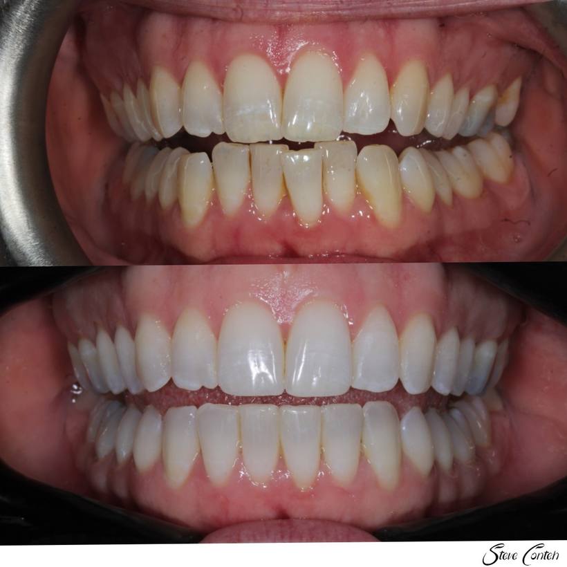 Invisalign and whitening corrected the crossbite and perfected this smile.