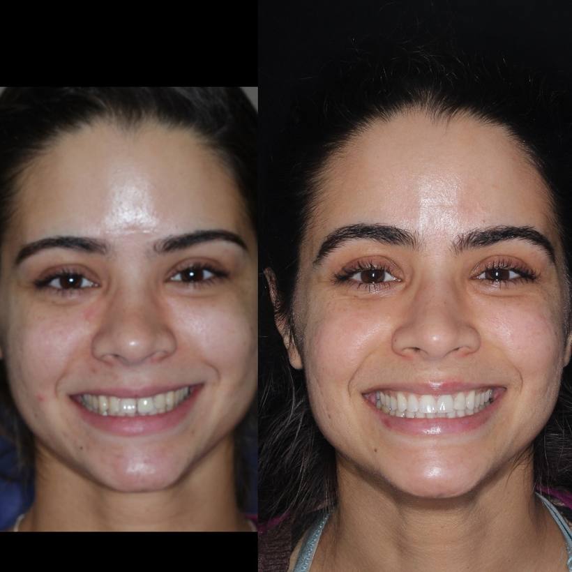 Invisalign, whitening, composite bonding and a new crown perfected this smile for his lovely lady!