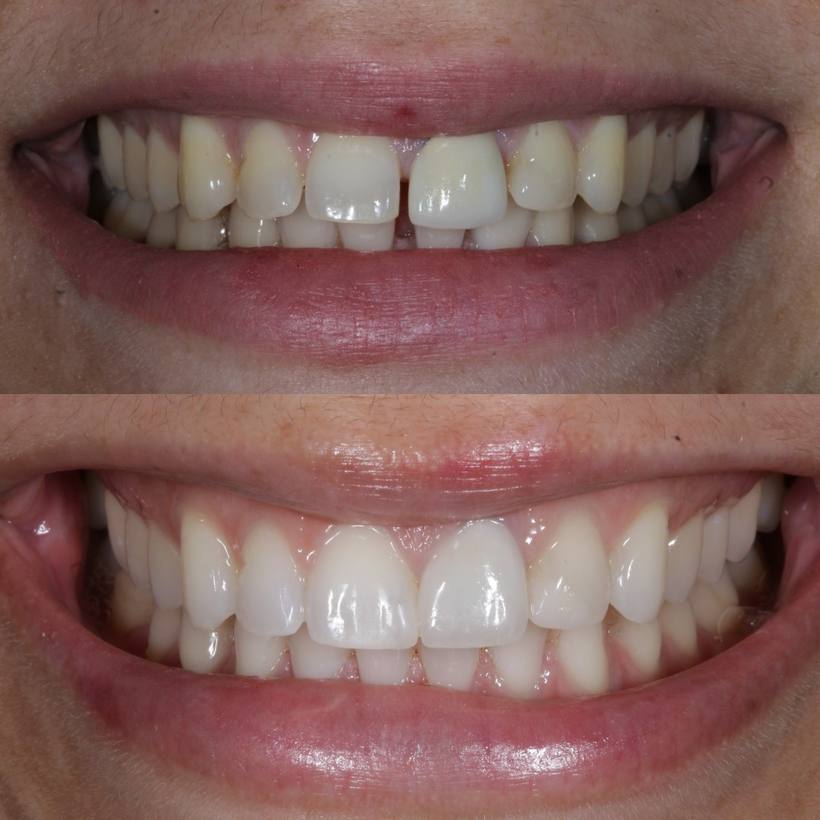 Invisalign, whitening, composite bonding and a new crown perfected this smile for his lovely lady!