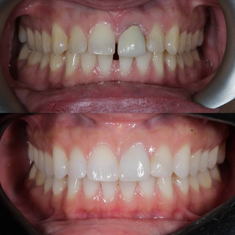 Invisalign, whitening, composite bonding and a new crown perfected this smile for his lovely lady!
