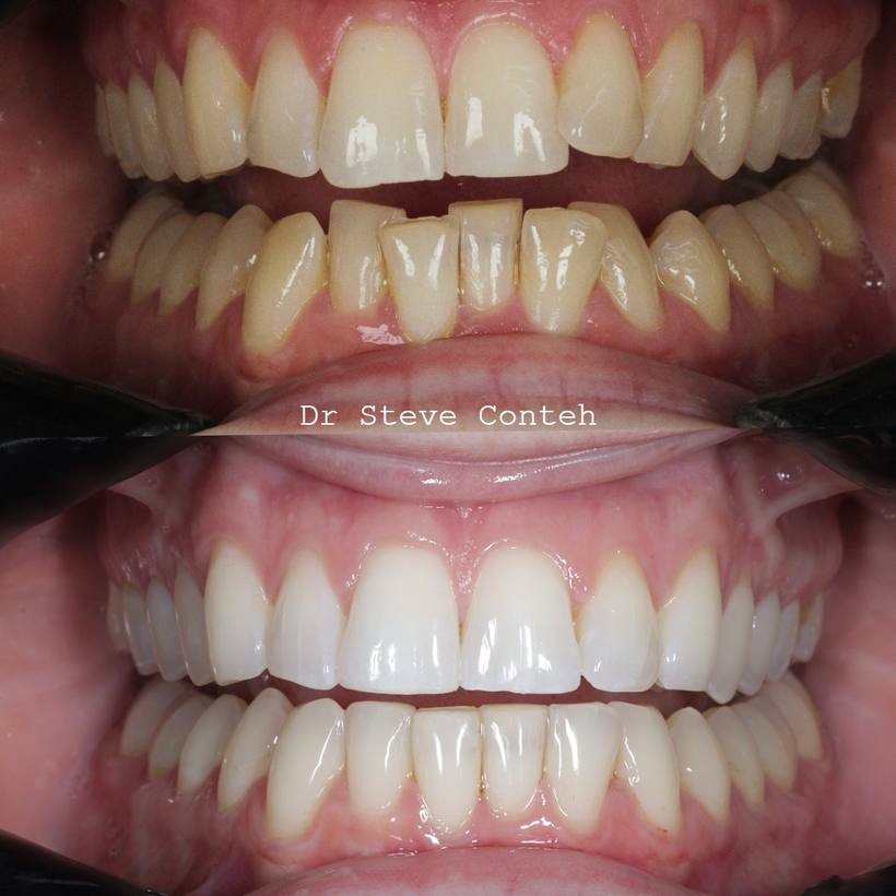 Invisalign and whitening, perfected this smile for his lovely lady!