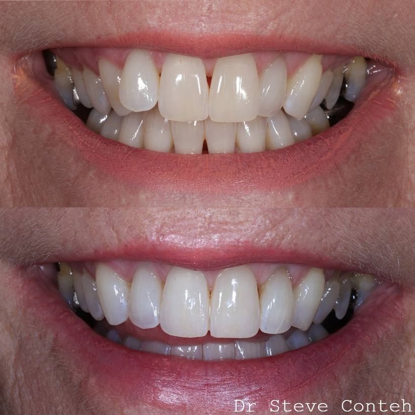 Invisalign and whitening, perfected this smile for his lovely lady!