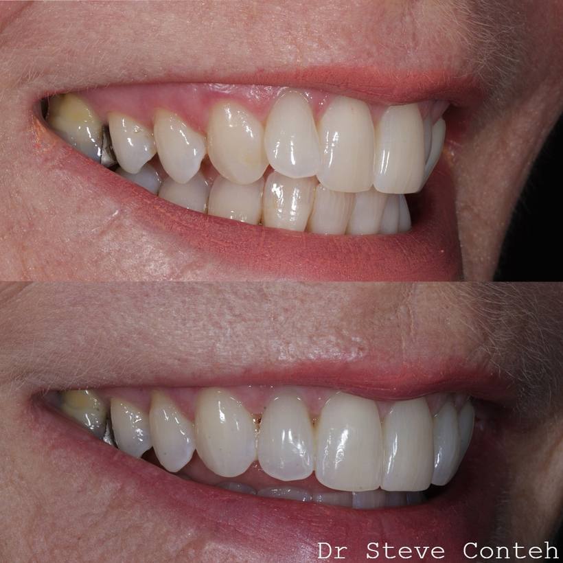 Invisalign and whitening, perfected this smile for his lovely lady!
