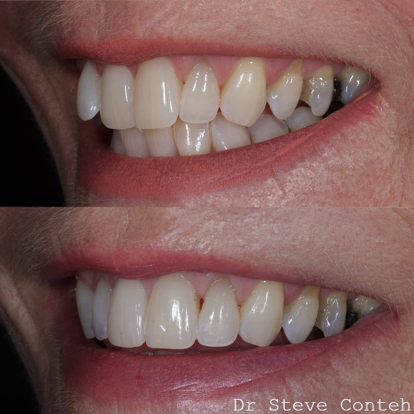 Invisalign and whitening, perfected this smile for his lovely lady!