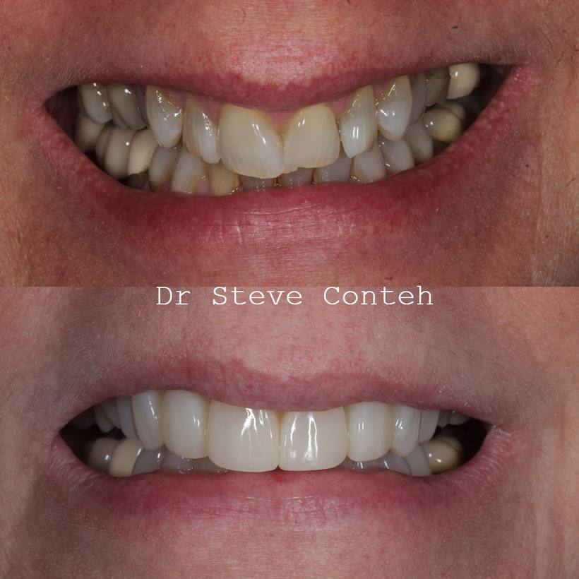 Tooth whitening and composite bonding gave this lovely lade lady her smile back after some difficult medical challenges.