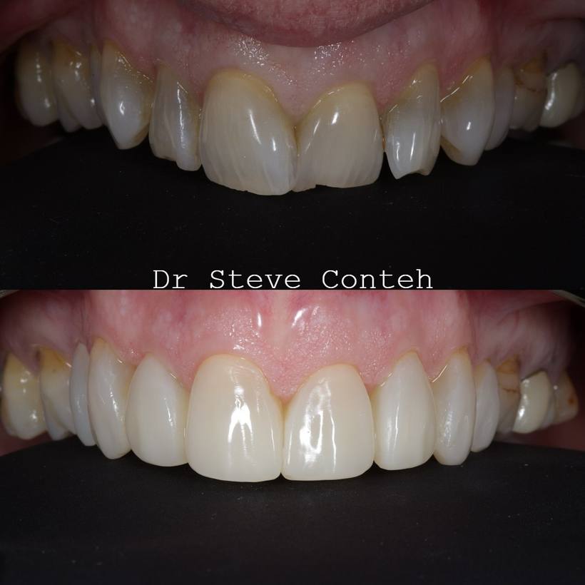 Tooth whitening and composite bonding gave this lovely lade lady her smile back after some difficult medical challenges.