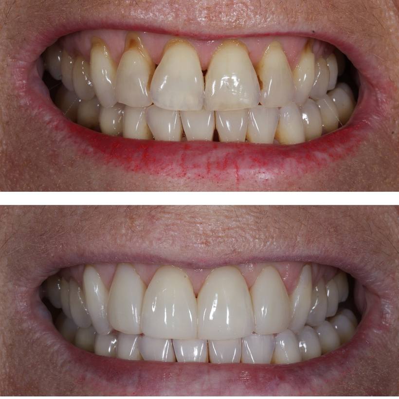 This lady did not like the spaces between her teeth and gums, or the discoloured appearance of her teeth which had worn 