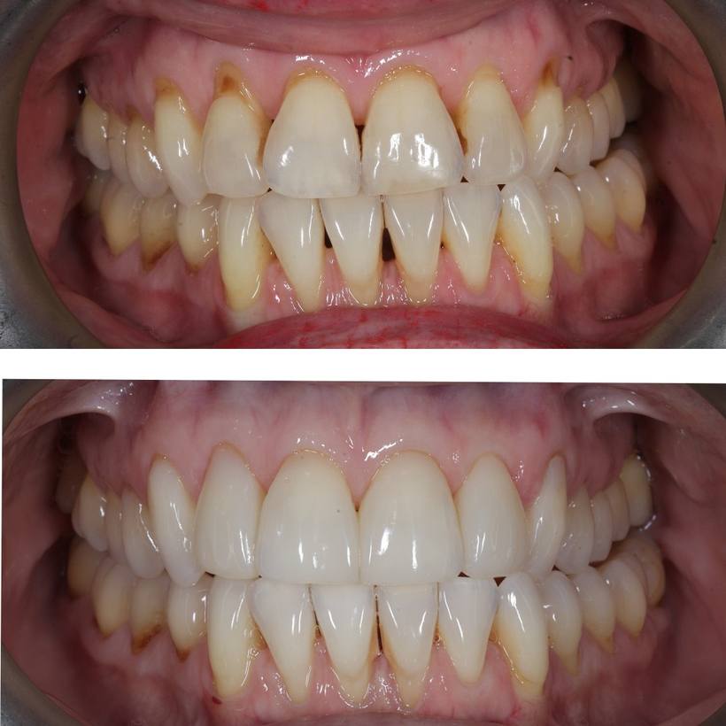 This lady did not like the spaces between her teeth and gums, or the discoloured appearance of her teeth which had worn 