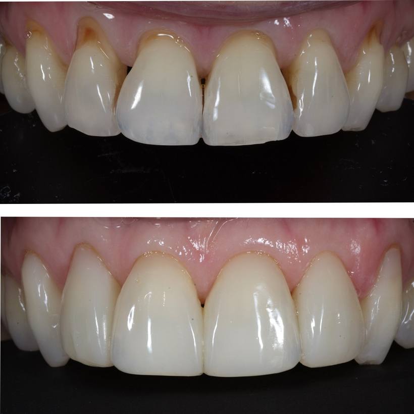 This lady did not like the spaces between her teeth and gums, or the discoloured appearance of her teeth which had worn 