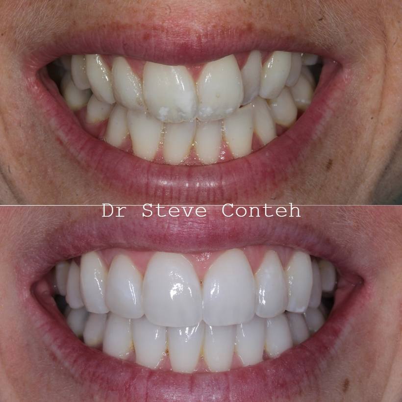 A – Align (Invisalign) B – Brighten (Whitening) C – Composite bonding