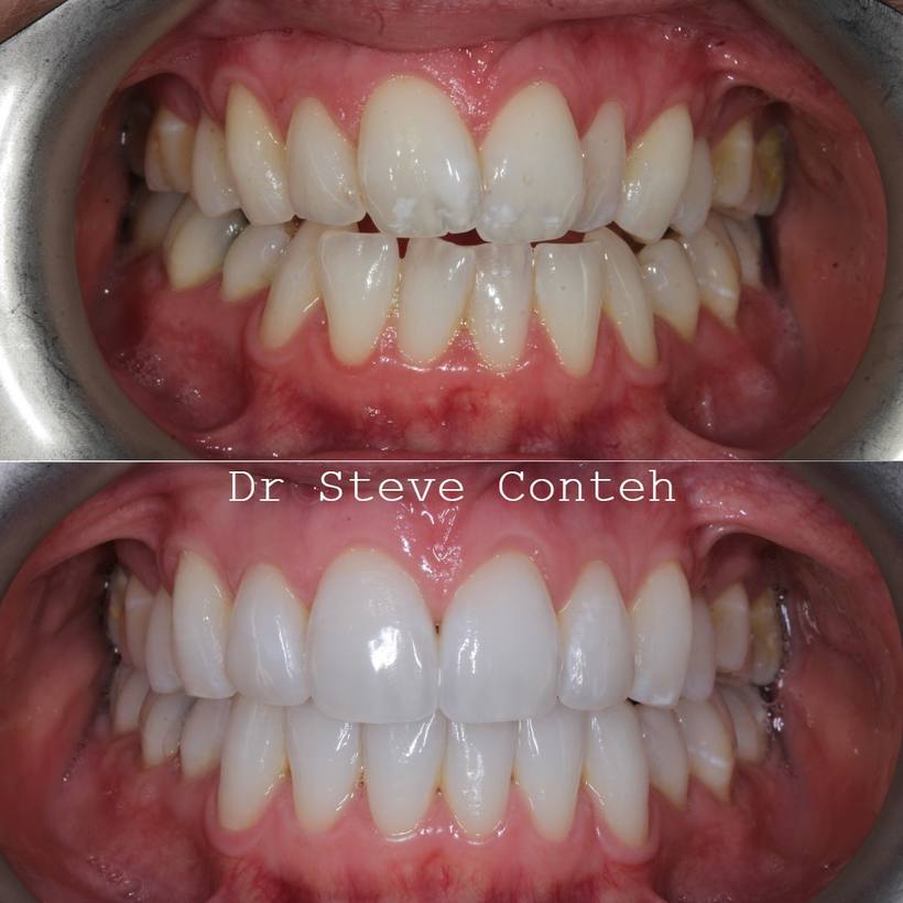 A – Align (Invisalign) B – Brighten (Whitening) C – Composite bonding