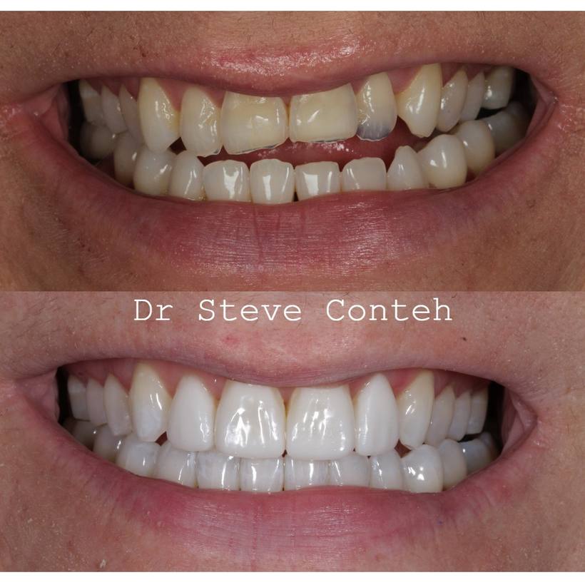 Invisalign, whitening and composite bonding helped transform this smile that was previously damages by acid wear.