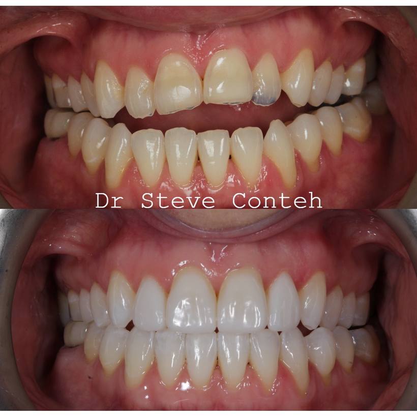 Invisalign, whitening and composite bonding helped transform this smile that was previously damages by acid wear.