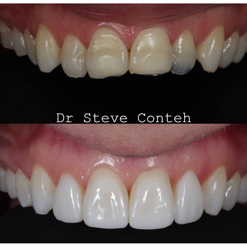 Invisalign, whitening and composite bonding helped transform this smile that was previously damages by acid wear.