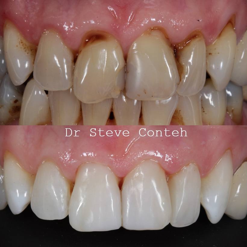 A quick composite upgrade of these teeth after some tooth whitening!