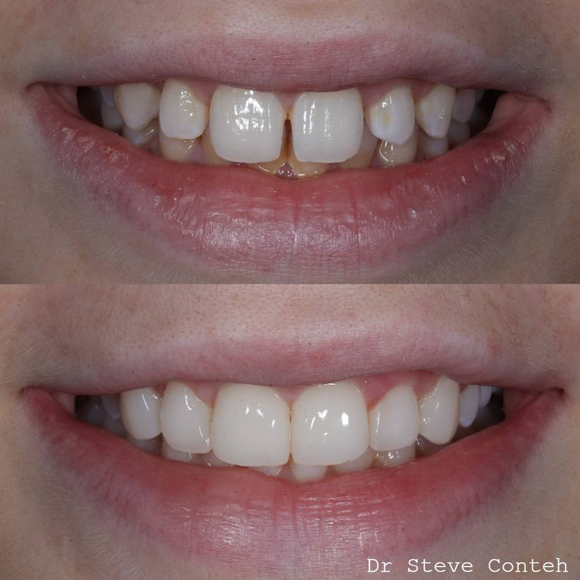 Invisalign and composite bonding improved the position and shape of these teeth for natural smile.