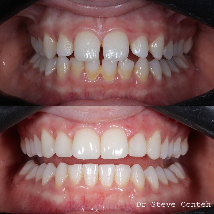 Invisalign and composite bonding improved the position and shape of these teeth for natural smile.
