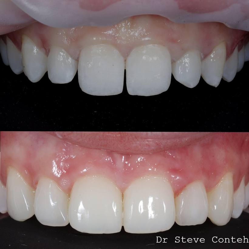 Close up of the composite bonding showing a seamless transition from composite to natural tooth.