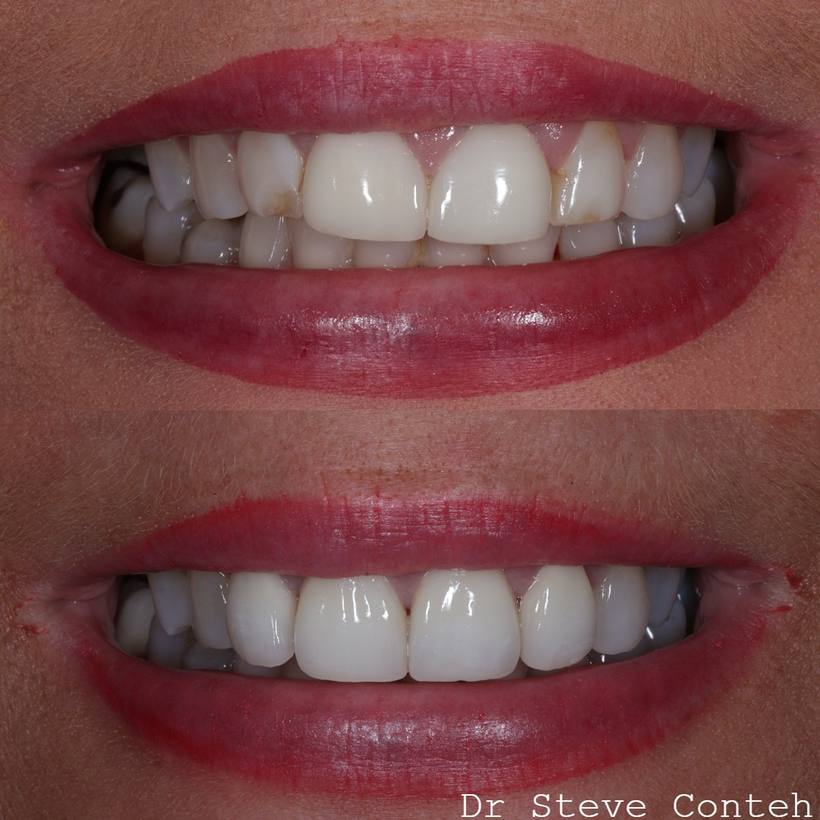 Porcelain veneers before and after