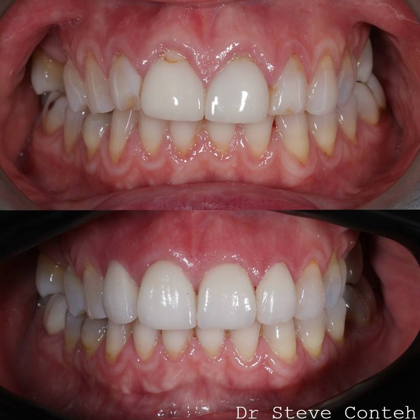 Four porcelain veneers were placed here to straighten the front teeth, improve proportions and harmonise this smile.