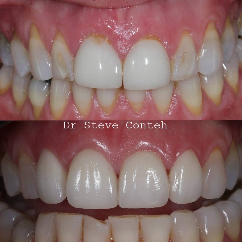 Four porcelain veneers were placed here to straighten the front teeth, improve proportions and harmonise this smile.