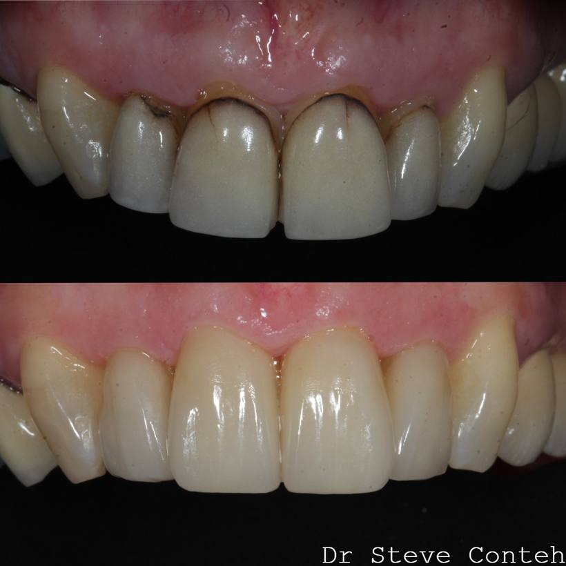 Four old, leaking porcelain veneers were replaced here to improve the health and aesthetics of this smile.