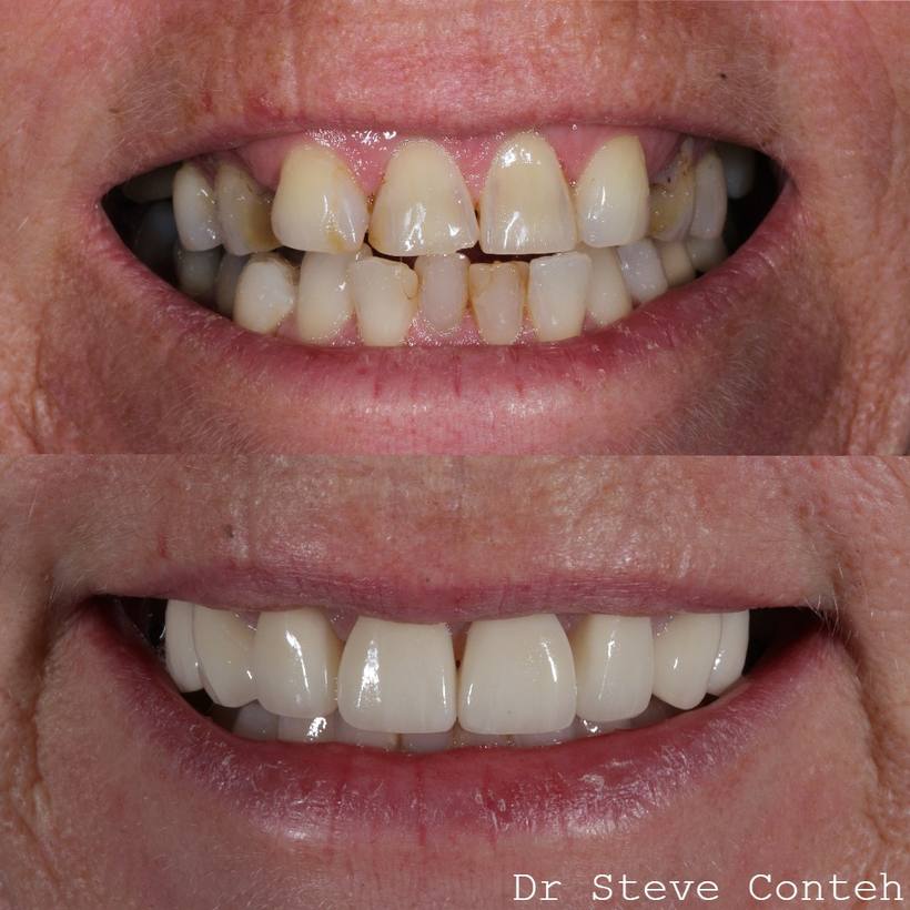 Invisalign, whitening and eight porcelain veneers transformed this smile!