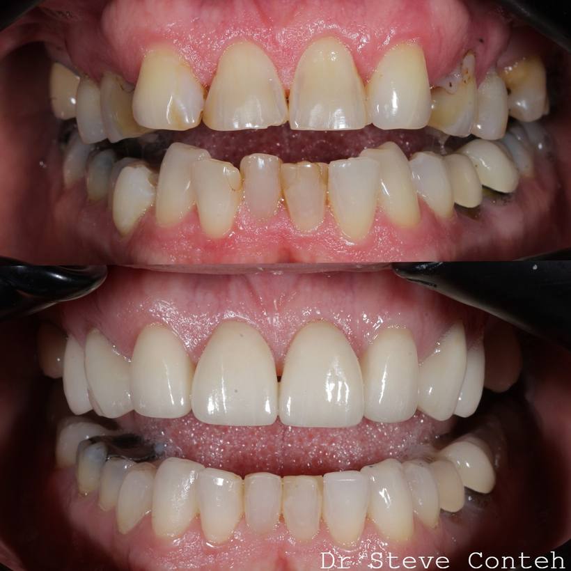 Invisalign, whitening and eight porcelain veneers transformed this smile!