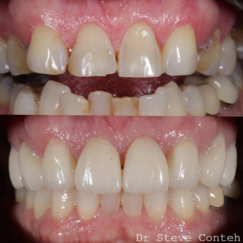 Invisalign, whitening and eight porcelain veneers transformed this smile!