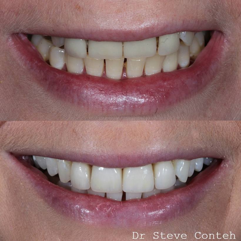 Four old, leaking porcelain veneers were replaced here to improve the health and aesthetics of this smile.