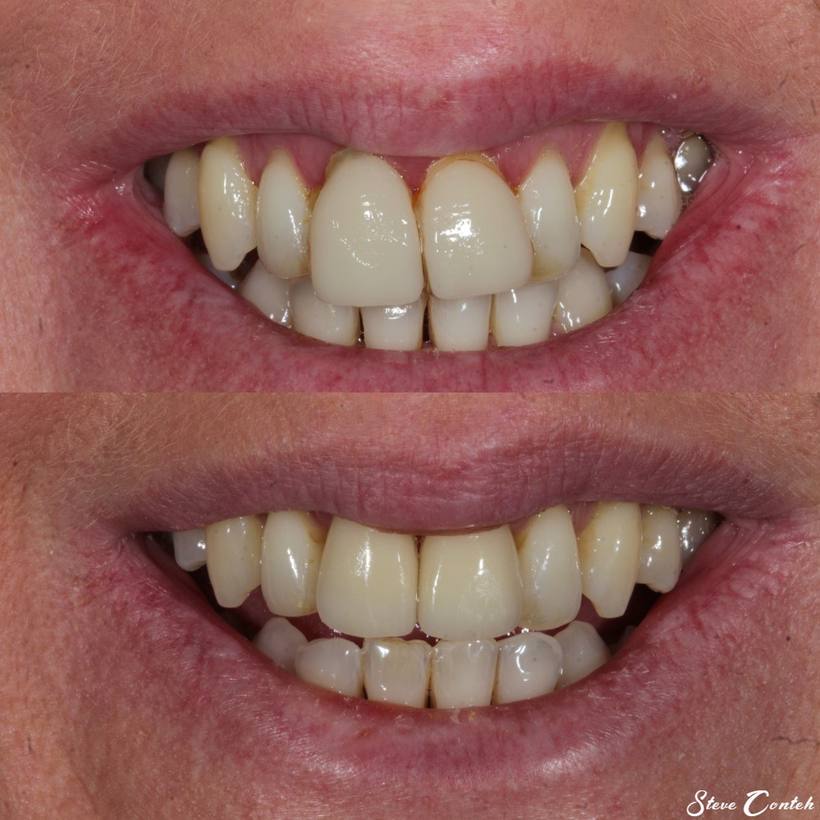 Misaligned veneers on the front two teeth were replaced to harmonise with this smile for a natural result.