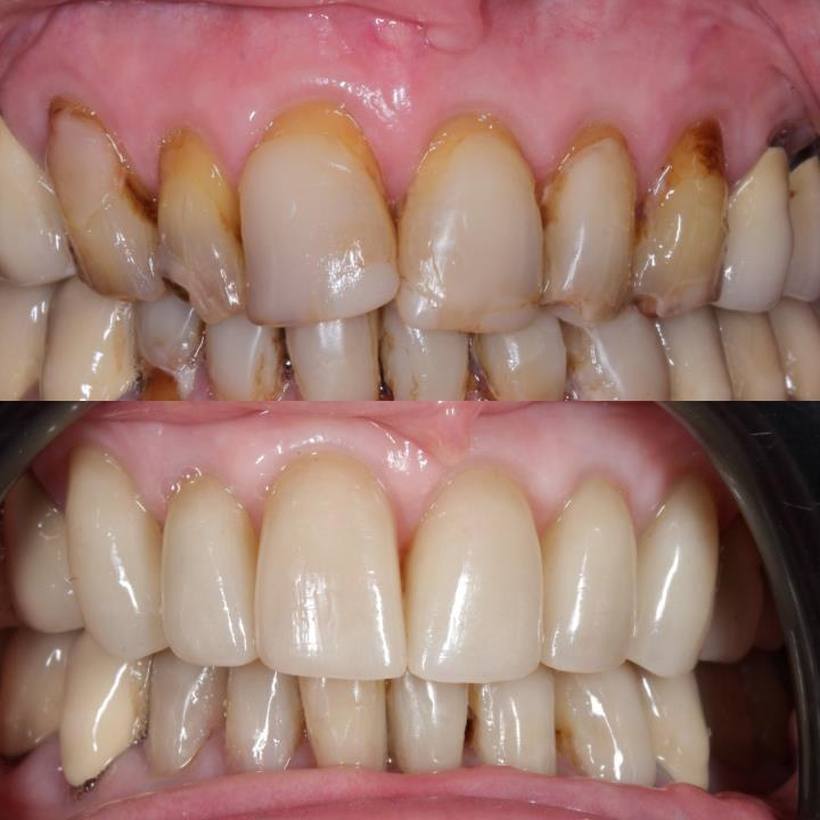 A new lease of life has been given to these teeth with porcelain veneers!