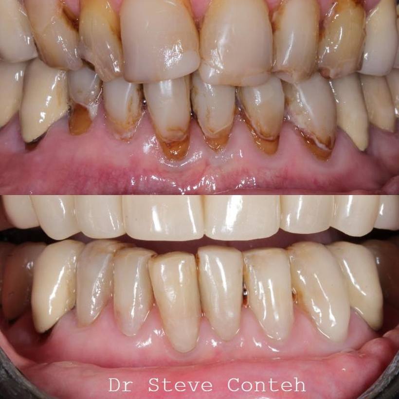 Composite bonding on the lower 6 teeth restored the worn and broken areas of these teeth near the gum.