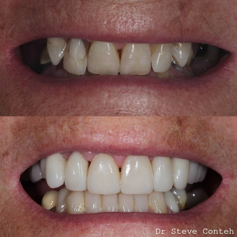 A combination of porcelain veneers, composite bonding and implants has given new confidence to this lady and her smile!