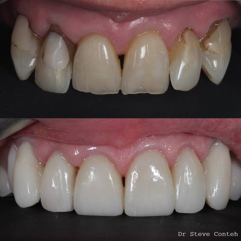 Porcelain veneers do not need to look fake. With the right clinician/technician, subtle details maintain a natural look