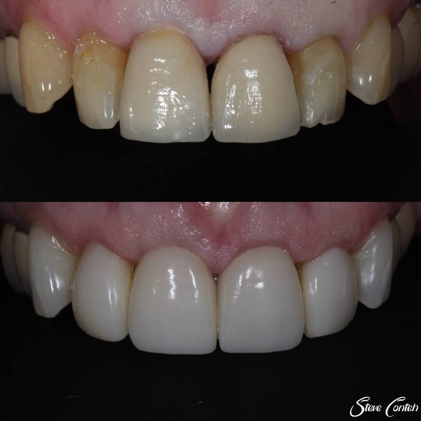 New crowns and veneers rejuvenated these teeth!