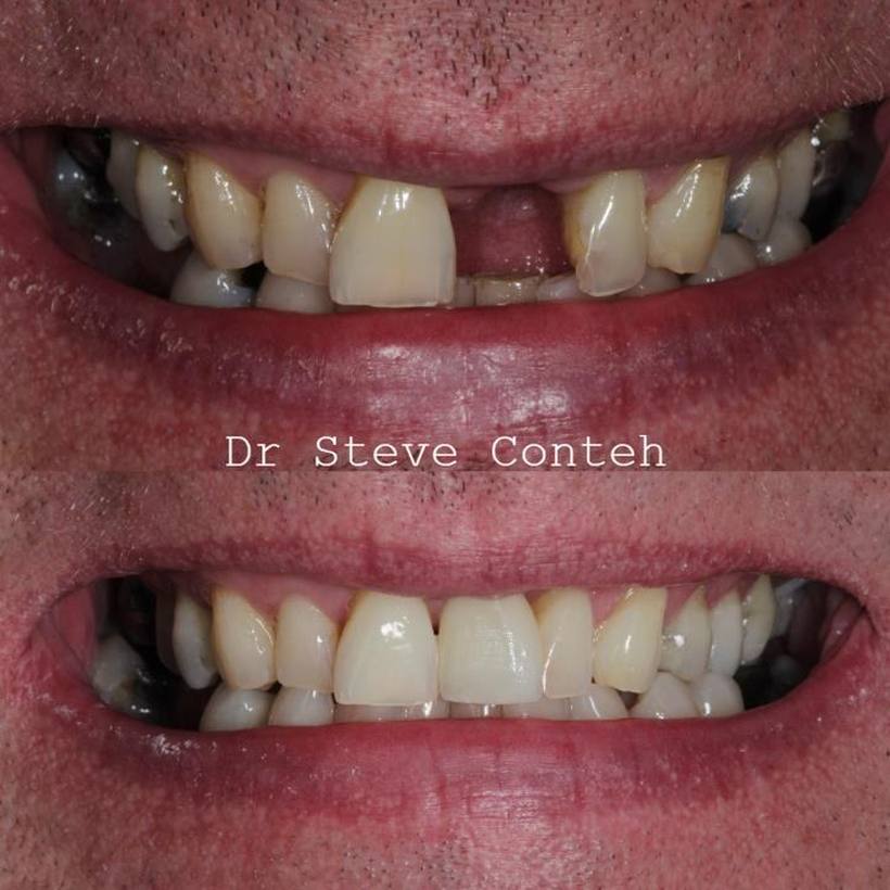 An implant supported crown was used to replace this missing front tooth which fractured.