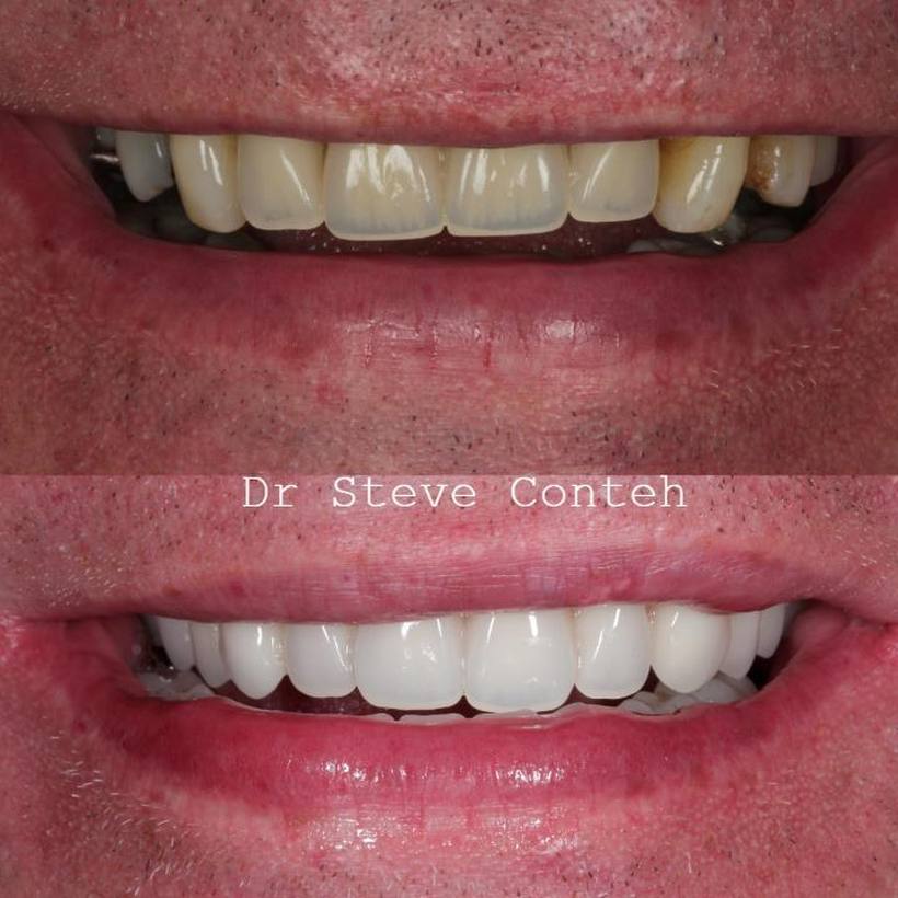Full-arch implant rehabilitation before and after