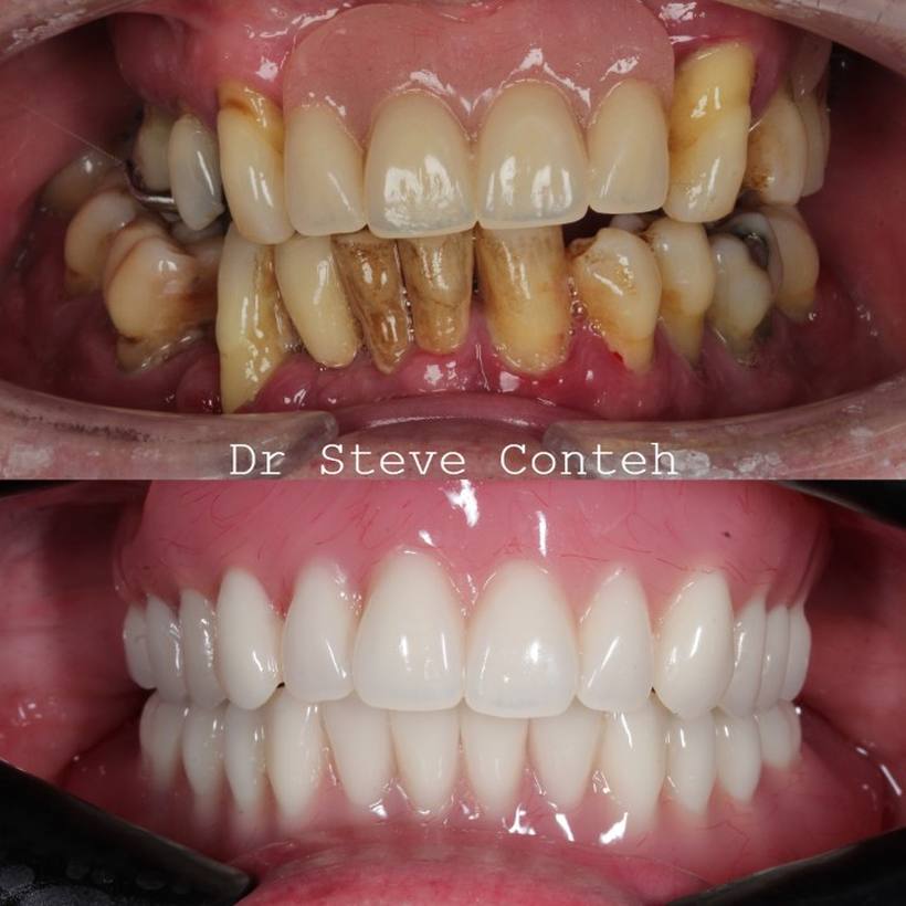Unhealthy teeth and a loose denture have been replaced by implant supported teeth.